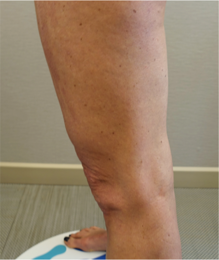 Knee Contouring Kybella Patient #1 Before Photo Thumbnail # 7