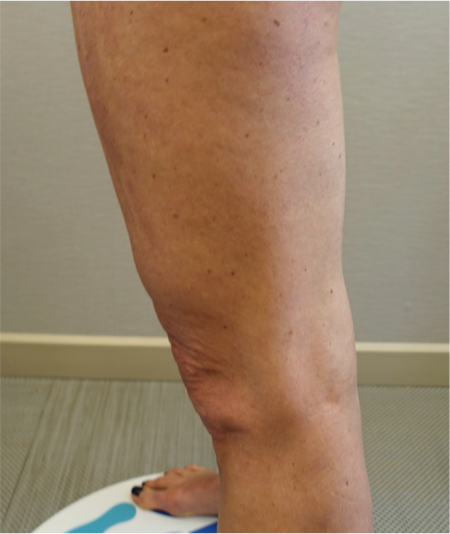 Before Image: Knee Contouring Kybella Patient #1 -