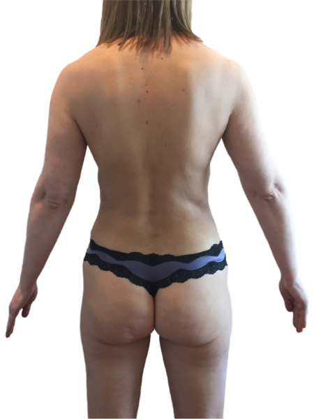 After Image: Breast Augmentation (Fat) Patient #2 -