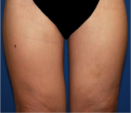 Thigh-Lift Patient #1 After Photo Thumbnail # 2