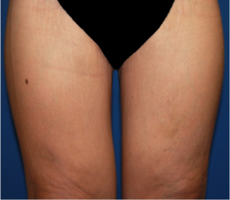 Thigh Lift Patient