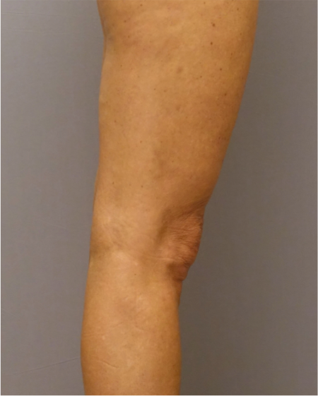 Knee Contouring Kybella Patient #1 After Photo # 10