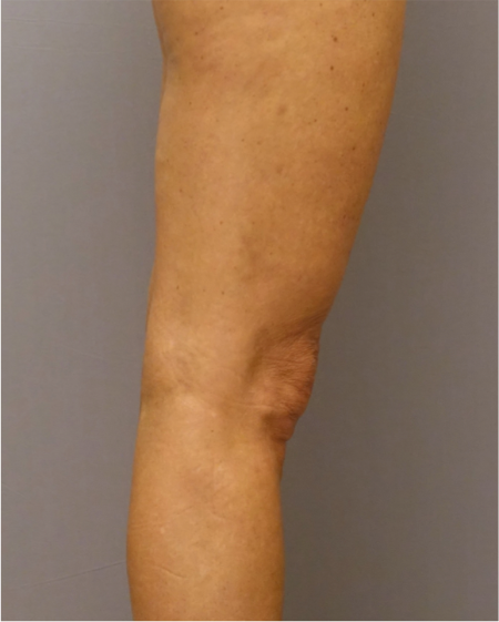 After Image: Knee Contouring Kybella Patient #1 -