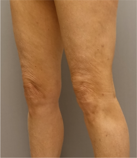 Knee Contouring Kybella Patient #2 After Photo # 4