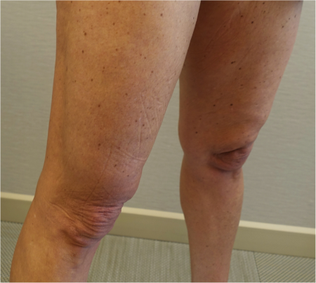 Knee Contouring Kybella Patient #1 Before Photo Thumbnail # 11