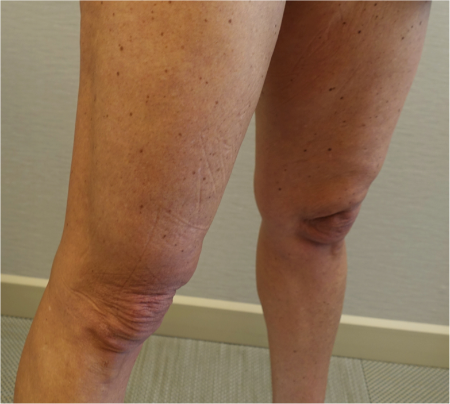 Before Image: Knee Contouring Kybella Patient #1 -