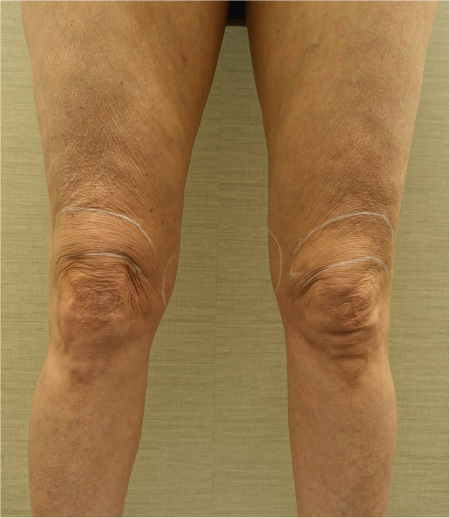 Knee Contouring Kybella Patient #2 Before Photo # 1