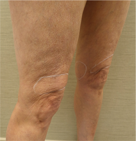 Knee Contouring Kybella Patient #2 Before Photo # 5