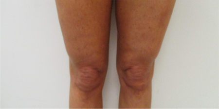Knee Contouring Kybella Patient #1 After Photo # 2