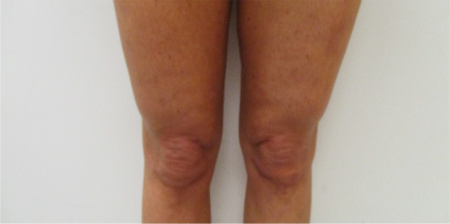 After Image: Knee Contouring Kybella Patient #1 - 