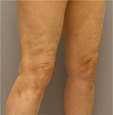 Knee Contouring Kybella Patient #2 After Photo Thumbnail # 6