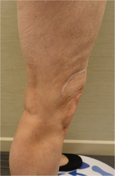 Knee Contouring Kybella Patient #2 Before Photo Thumbnail # 7