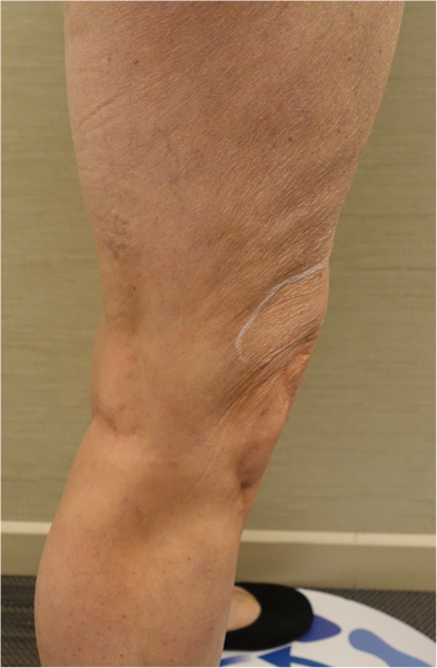 Knee Contouring Kybella Patient #2 Before Photo # 7