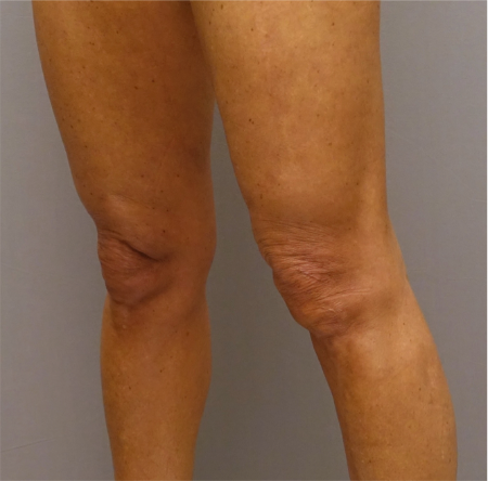 Knee Contouring Kybella Patient #1 After Photo Thumbnail # 6