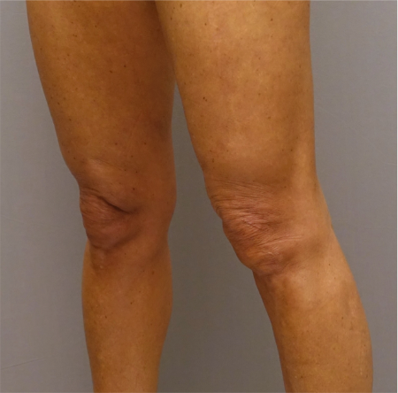 After Image: Knee Contouring Kybella Patient #1 -