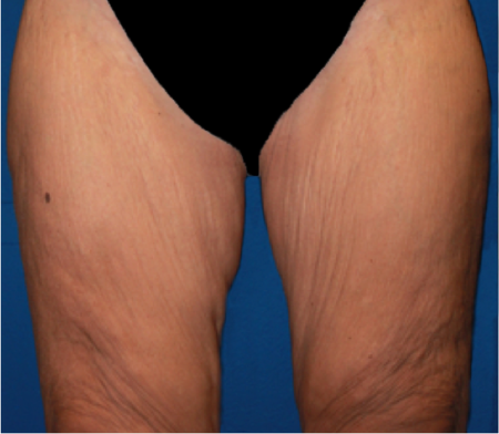 Thigh-Lift Patient #1 Before Photo # 1