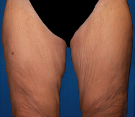 Thigh Lift Patient