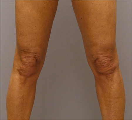 Knee Contouring Kybella Patient #1 After Photo Thumbnail # 4