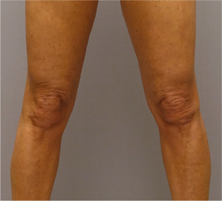 After Image: Knee Contouring Kybella Patient #1 -