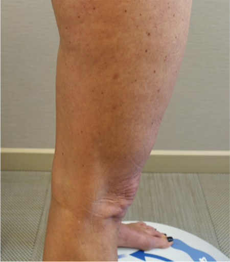 Before Image: Knee Contouring Kybella Patient #1 -
