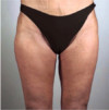 Thigh Lift Patient