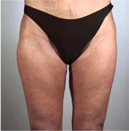 Thigh-Lift Patient #2 After Photo # 2