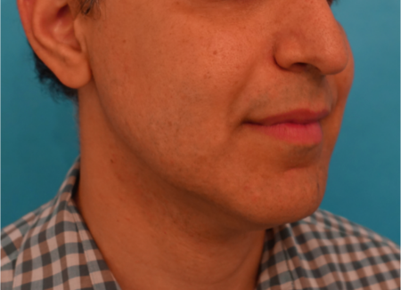 Jowl/Jawline Contouring Kybella Patient #7 After Photo # 4