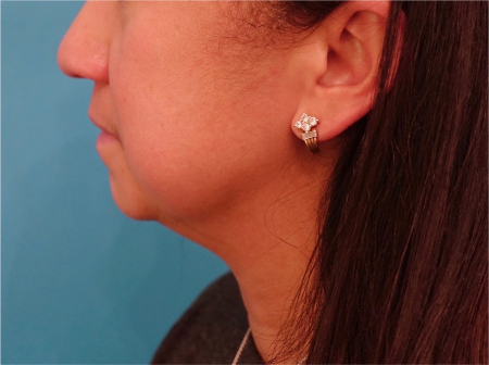 Before Image: Jowl/Jawline Contouring Kybella Patient #8 - 