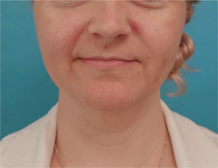 Jowl/Jawline Contouring Kybella Patient #10 Before Photo # 1