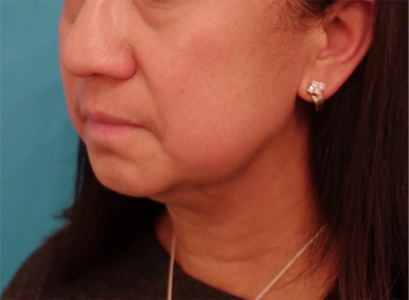 Before Image: Jowl/Jawline Contouring Kybella Patient #8 - 
