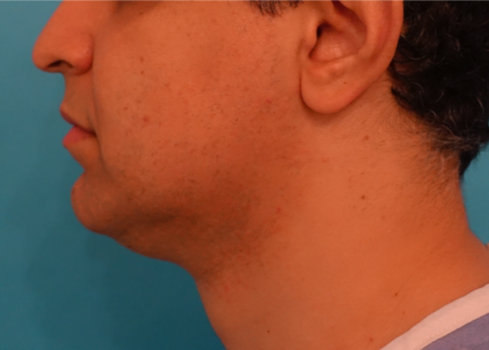 Jowl/Jawline Contouring Kybella Patient #7 Before Photo Thumbnail # 9