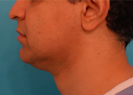 Jowl/Jawline Contouring Kybella Patient #7 Before Photo # 9