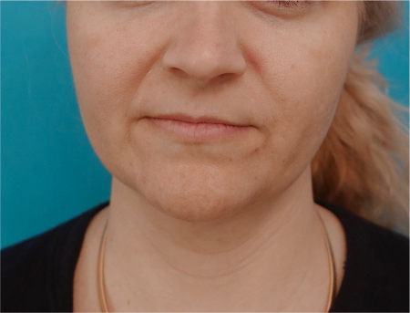 Jowl/Jawline Contouring Kybella Patient #10 After Photo # 2