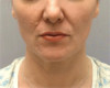 Jowl/Jawline Contouring Kybella Patient #9 After Photo Thumbnail # 2