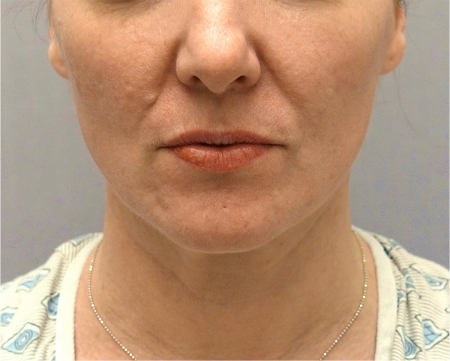 Jowl/Jawline Contouring Kybella Patient #9 After Photo # 2