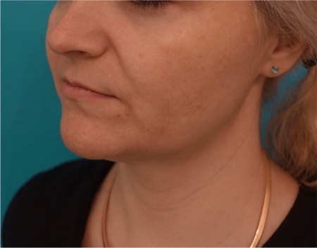 Jowl/Jawline Contouring Kybella Patient #10 After Photo # 8