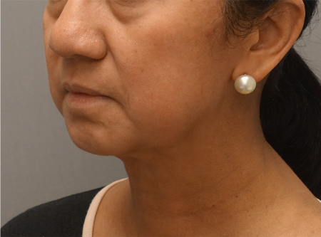 Jowl/Jawline Contouring Kybella Patient #8 After Photo # 8