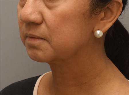 After Image: Jowl/Jawline Contouring Kybella Patient #8 - 