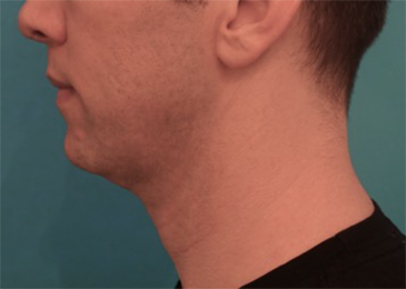 Jowl/Jawline Contouring Kybella Patient #11 Before Photo # 3