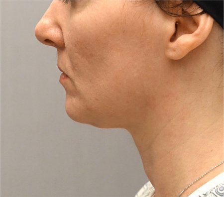 Jowl/Jawline Contouring Kybella Patient #9 After Photo # 10