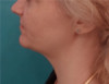 Jowl/Jawline Contouring Kybella Patient #10 After Photo Thumbnail # 10