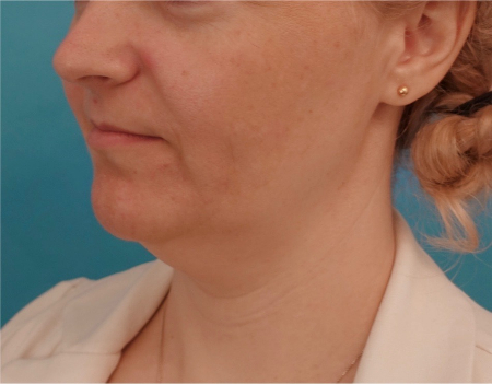 Jowl/Jawline Contouring Kybella Patient #10 Before Photo # 7