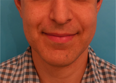 Jowl/Jawline Contouring Kybella Patient #7 After Photo Thumbnail # 2