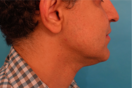 Jowl/Jawline Contouring Kybella Patient #7 After Photo # 6