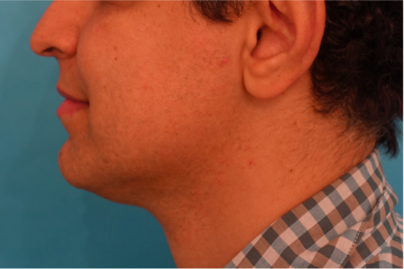 Jowl/Jawline Contouring Kybella Patient #7 After Photo Thumbnail # 10