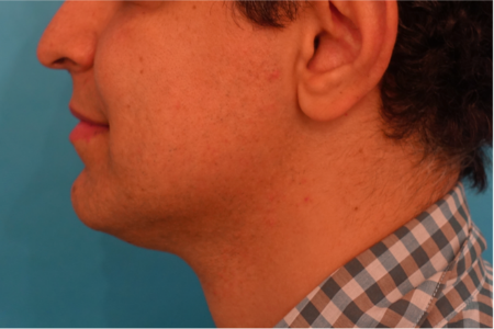 Jowl/Jawline Contouring Kybella Patient #7 After Photo # 10