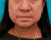 Jowl/Jawline Contouring Kybella Patient #8 Before Photo Thumbnail # 1
