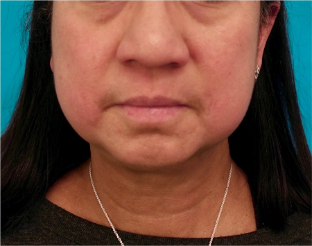 Before Image: Jowl/Jawline Contouring Kybella Patient #8 - 