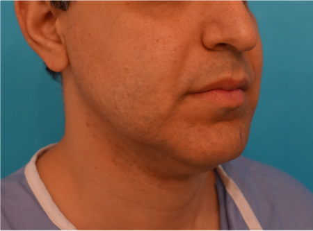 Jowl/Jawline Contouring Kybella Patient #7 Before Photo # 3