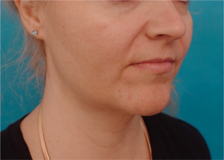 Jowl/Jawline Contouring Kybella Patient #10 After Photo # 4